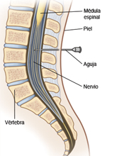 Posición de la aguja para la anestesia epidural